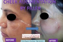 CHEEK AUGMENTATION before after image