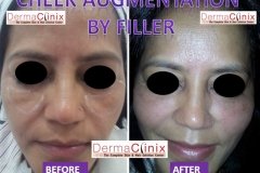 CHEEK AUGMENTATION before after photo by fillers