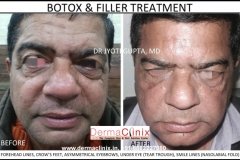 botox before after photo