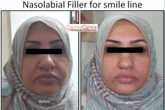 smile line before after images by fillers 