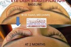 Eyelashes transplant results