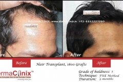 Hair-transplant-before-after-61