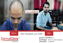 hair transplant results south delhi
