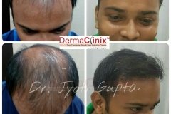 best-fue-hair-transplant-results
