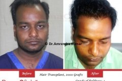 hair-transplant-before-after-40