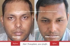 hair-transplant-before-after-46
