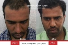 hair-transplant-before-after-47