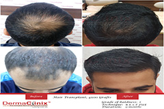hair transplant India.jpg
