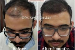 hair-transplant-result-26