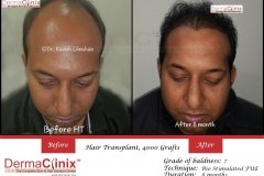 hair-transplant-result-32