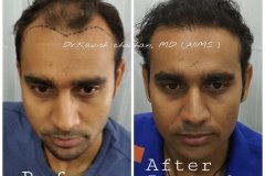 hair-transplant-result-58