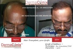 hair-transplant-result-60