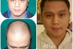 hair-transplant-result-young-age-34