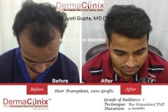 hair-transplant-results-36
