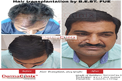 hair transplant reviews India