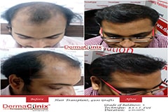 hair transplantation Delhi