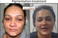 skin pigmentation treatment before after results