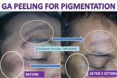 skin pigmentation before after results