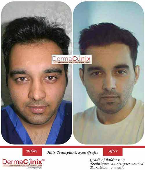 Hair Transplantation Results in Noida