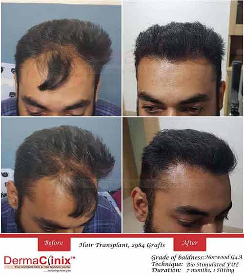 Hair Transplant before and after images