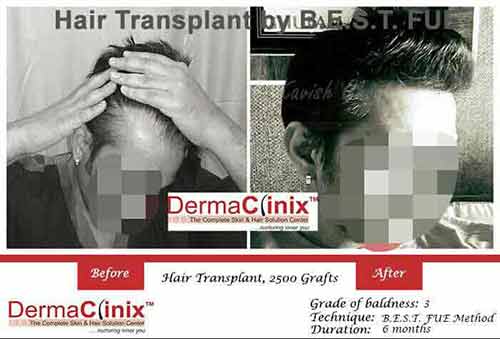 DermaClinix Hair Transplant Results