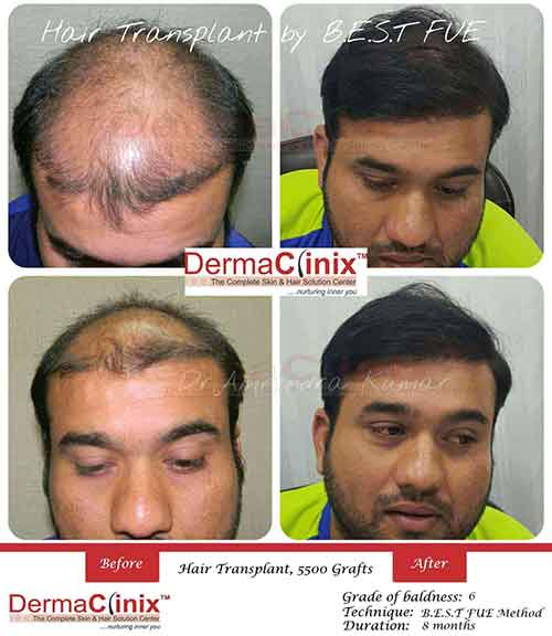 Best Hair Transplant in Kochi | Hair Transplant Cost in Kochi, Kerala:  DermaClinix