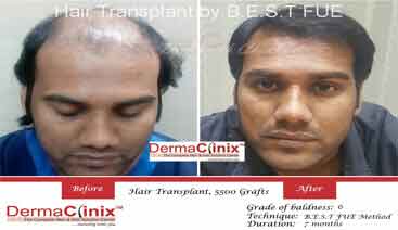 Hair Transplant before after Noida