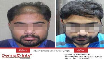 Hair Transplant before after photos in In Noida