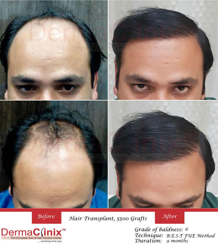 Best Hair Transplantation Doctor in Delhi | Hair Transplant Doctor