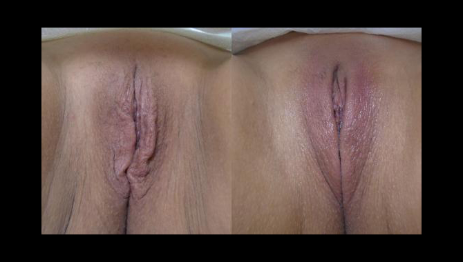 thermiVa before after vaginal tightening surgery results