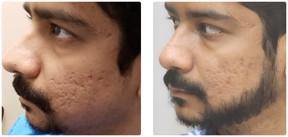 Beard Transplantation