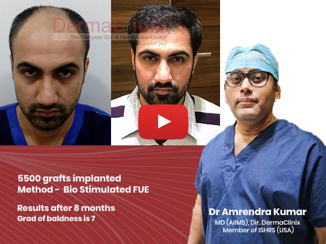 FUE Hair Transplant Videos, Results and Patients Reviews India : DermaClinix