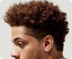 delhi hair transplant