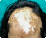 delhi hair transplant