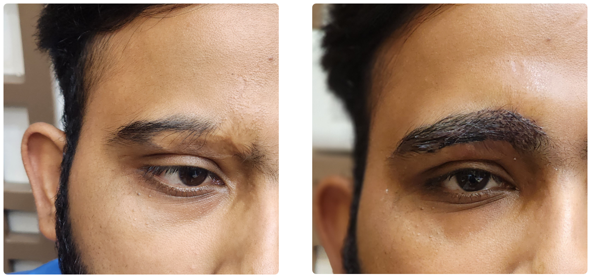 Eyebrow Restoration