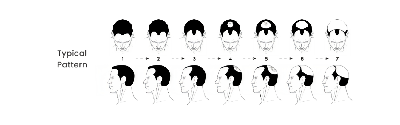 Best hair transplant in delhi graft