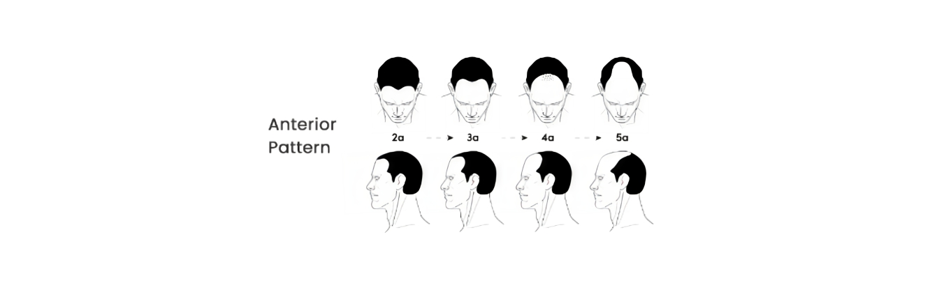 Best hair transplant in delhi graft