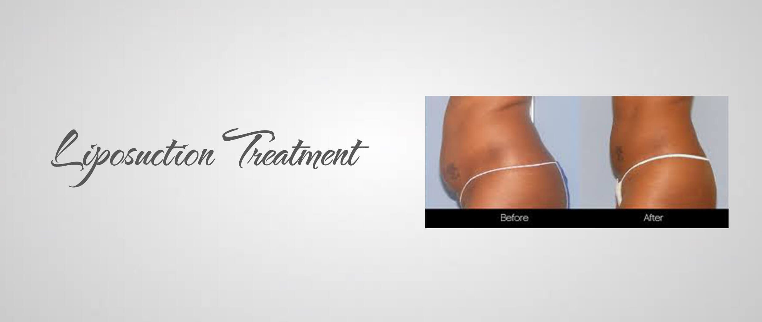 best liposuction treatment in south delhi