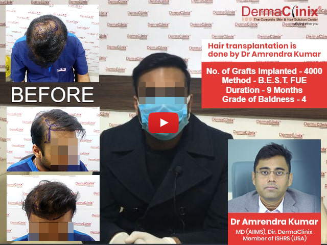 Best Hair Transplant in Delhi | Hair Transplantation Cost in South Delhi