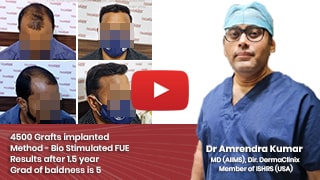 dr amrendra kumar hair transplant reviews