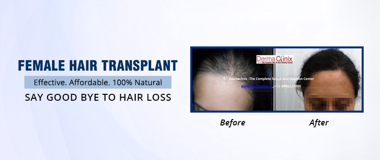 Female Hair Transplant in Delhi | Women Hair Transplant cost in India:  DermaClinix