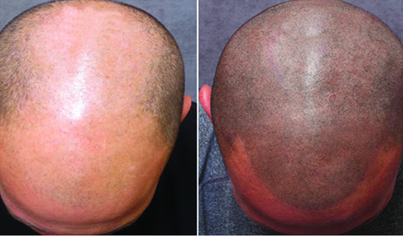 Scalp Micropigmentation treatment before after