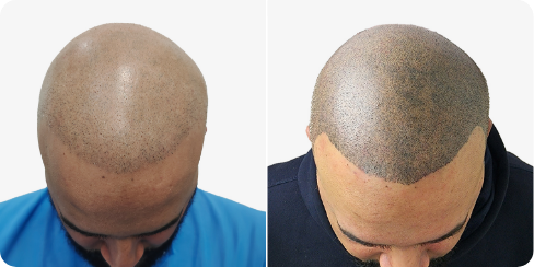 Scalp Micropigmentation