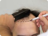 delhi hair transplant
