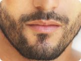 delhi hair transplant