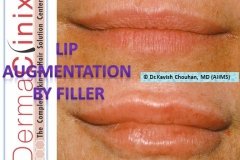 Lip augmentation before after photo