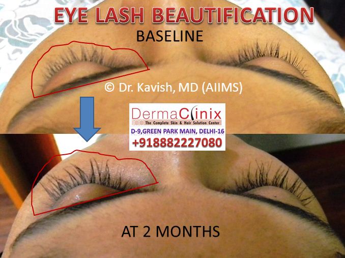 Eyebrow Eyelashes Transplant Before After Results in Delhi India -  DermaClinix