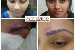eyebrow transplant  before after results
