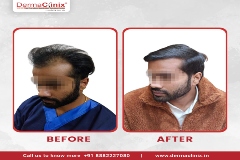 hair transplant results Delhi