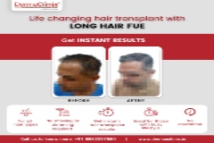 Long hair non shaven FUE transplant results